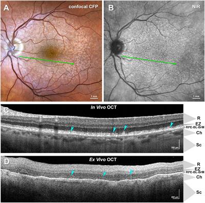 Lysolipids are prominent in subretinal drusenoid deposits, a high-risk phenotype in age-related macular degeneration